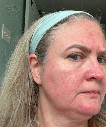 serum for maturing skin redness