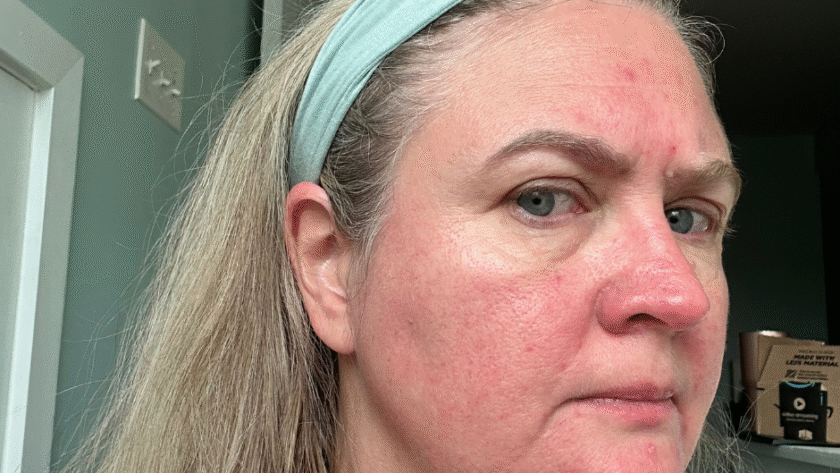serum for maturing skin redness