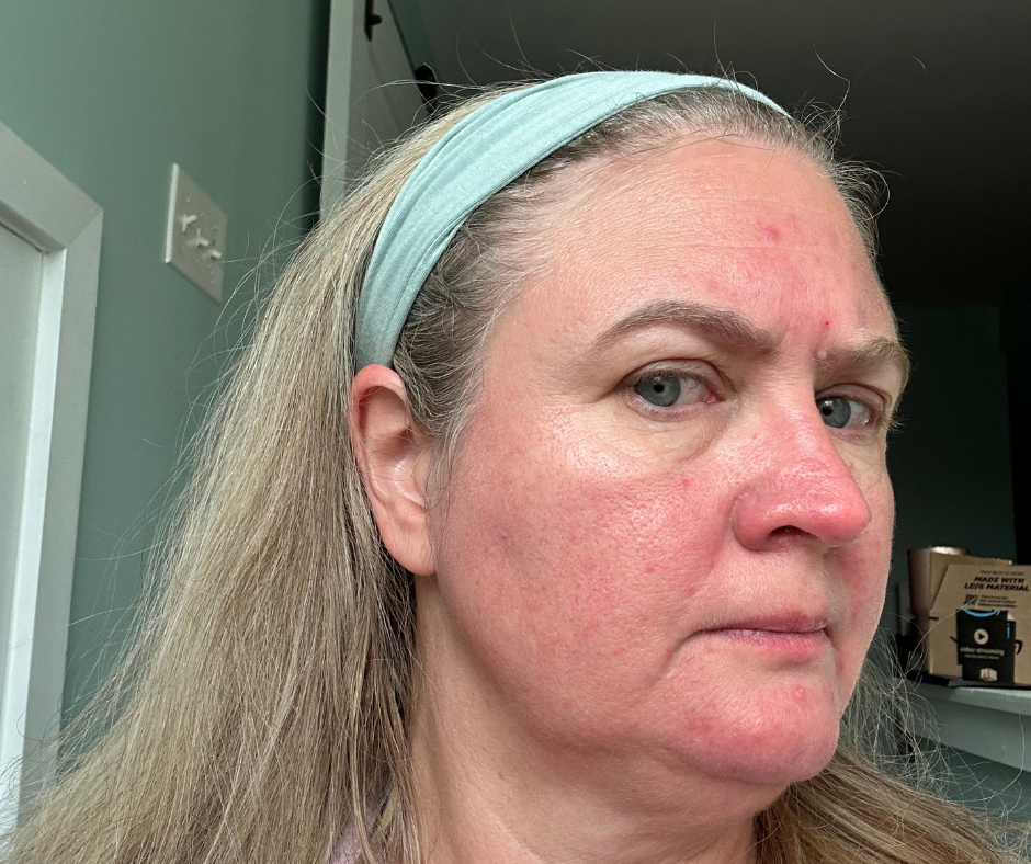 serum for maturing skin redness